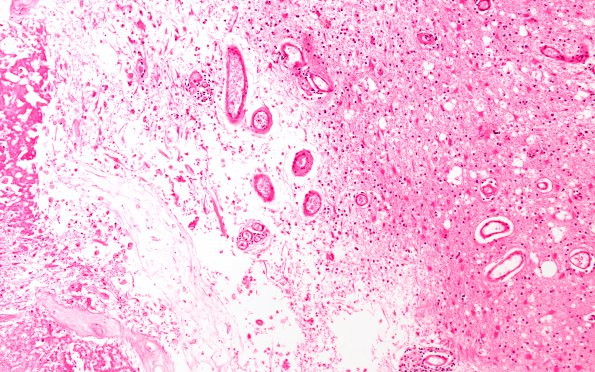 11B6 Cerebroretinal Vasculopathy, CRV, RVCL, TREX, HERNS, Case 11, Autopsy) 1A