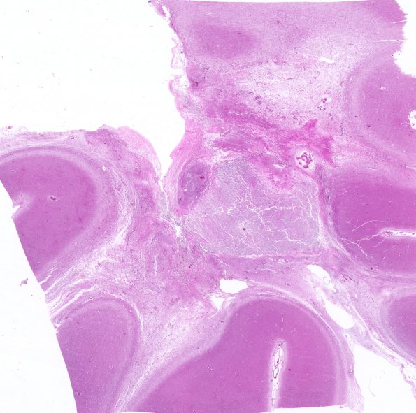 12A3 Cerebroretinal Vasculopathy, CRV, RVCL, TREX, HERNS, Case 12 H&E WM 1