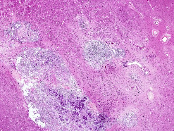 12B1 Cerebroretinal Vasculopathy, CRV, RVCL, TREX, HERNS, Case 12) H&E 5