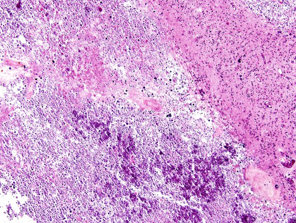 12B2 Cerebroretinal Vasculopathy, CRV, RVCL, TREX, HERNS, Case 12) H&E 4