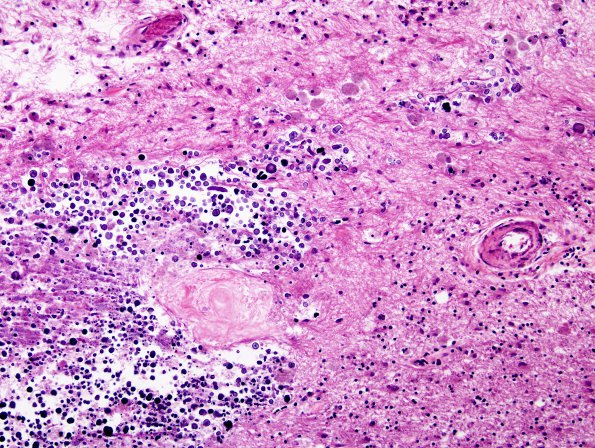 12B3 Cerebroretinal Vasculopathy, CRV, RVCL, TREX, HERNS, Case 12) H&E 3