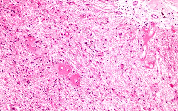 12B5 Cerebroretinal Vasculopathy, CRV, RVCL, TREX, HERNS, Case 12) H&E 2