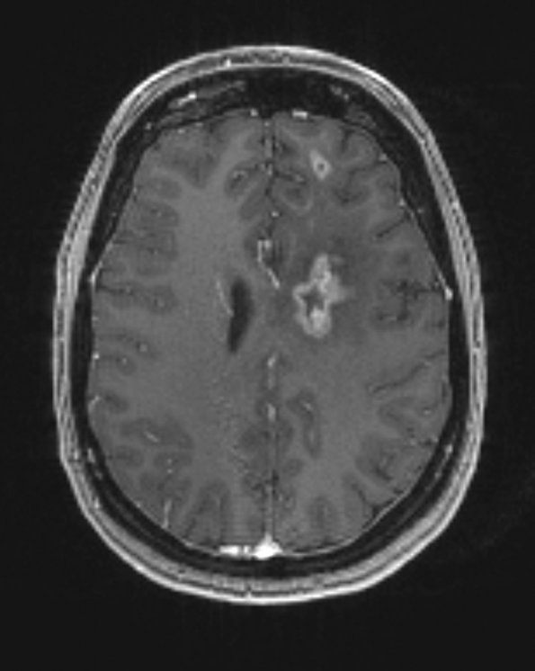 15A2 (Case 15) T1 with contrast 4 - Copy