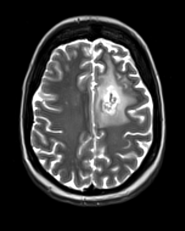 15A4 (Case 15) T2 with contrast - Copy