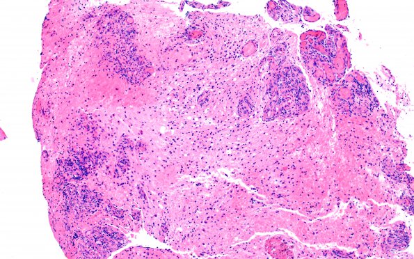 15B2 CRV (Case 15) A3 H&E 10X 2
