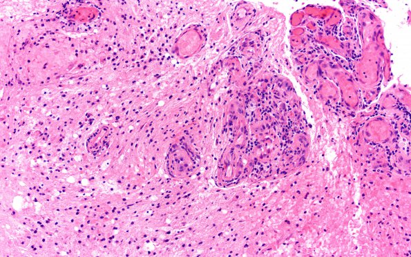 15B3 CRV (Case 15) A3 H&E 20X 1