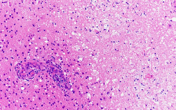 15B4 CRV (Case 15) A3 H&E 20X