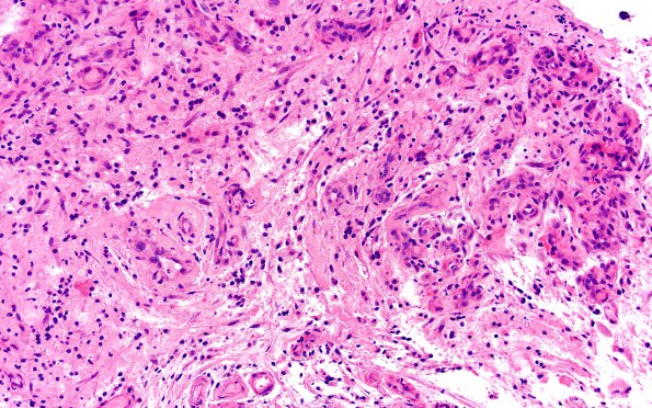 15B5 CRV (Case 15) A1 H&E 20X 2