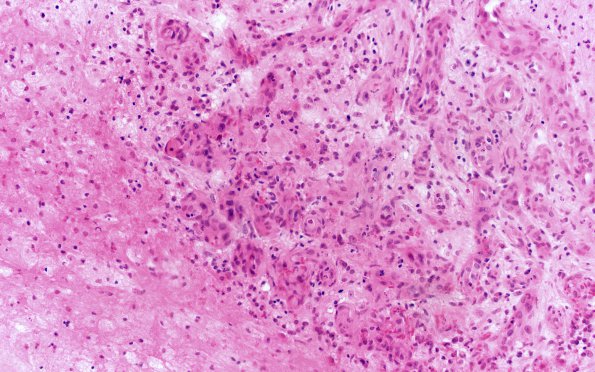 15B6 CRV (Case 15) A4 H&E 20X 1