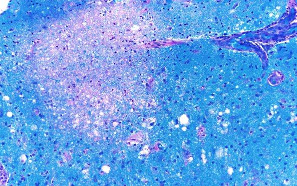 15C2 CRV (Case 15) A3 LFB-PAS 20X 1