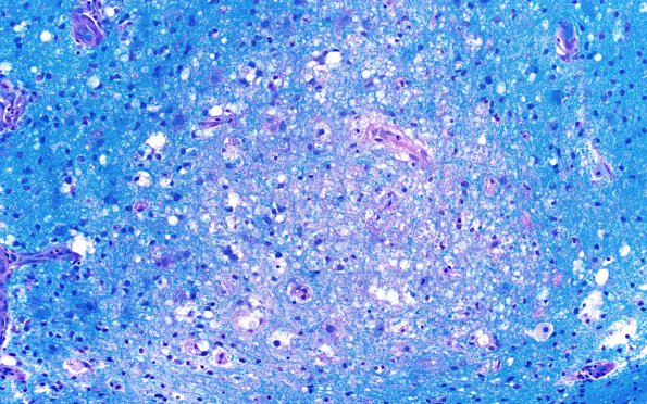 15C3 CRV (Case 15) A3 LFB-PAS 20X 2