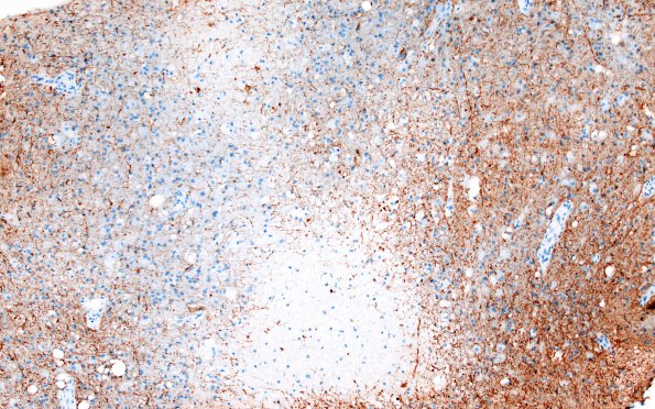 15D1 CRV (Case 15) A3 NF 10X