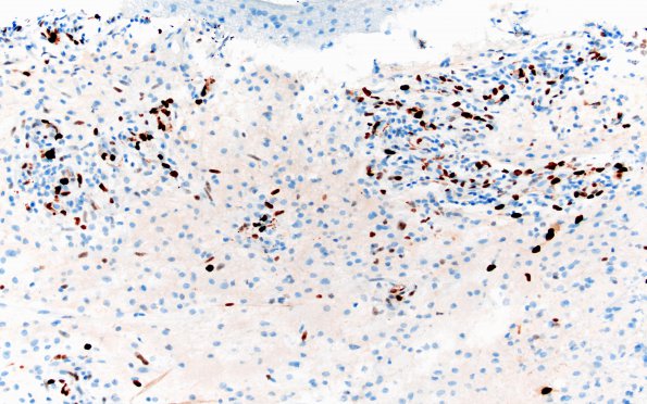 15H2 CRV (Case 15) A3 Ki67 20X 1