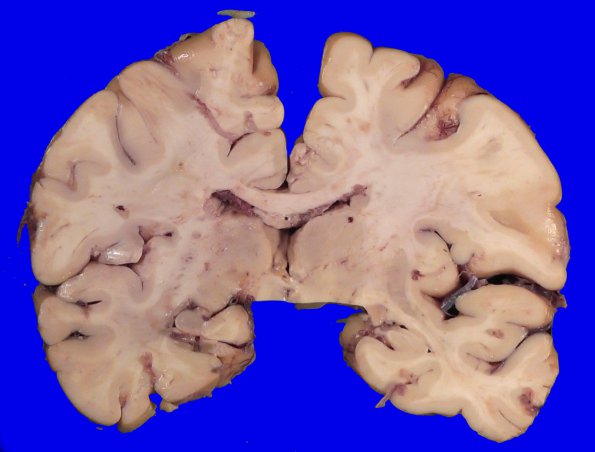 16A1 RVCL (Case16) 3