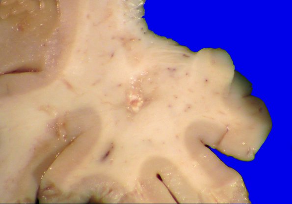 16A2 RVCL (Case16) 5