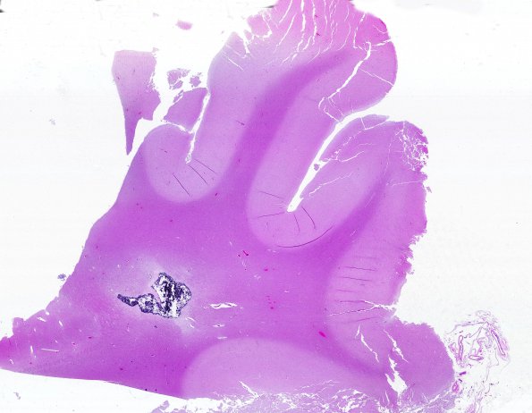 16B1 RVCL (Case16) N11 H&E WM