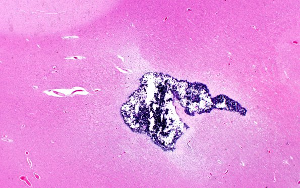 16B2 RVCL (Case16) N11 H&E 2X