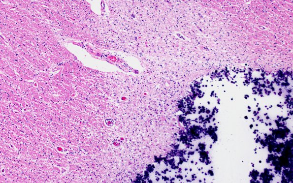 16B3 RVCL (Case16) N11 H&E 10X