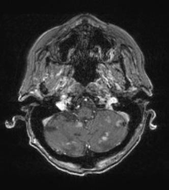 17A3 (Case 17) T1W 2 - Copy