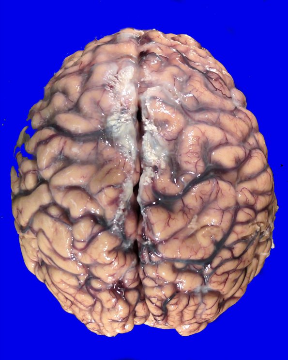 17B1 RVCL (Case 17) Gross _1