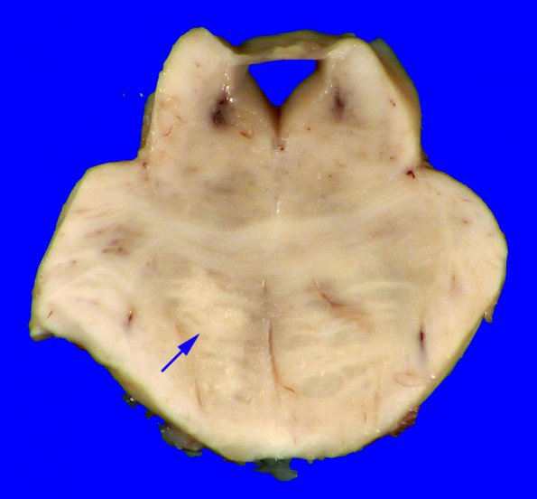 17B10 RVCL (Case 17) Gross _25 copy