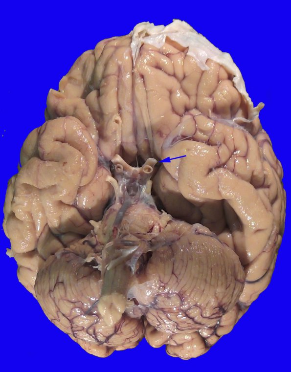 17B2  RVCL (Case 17) Gross 0 _1