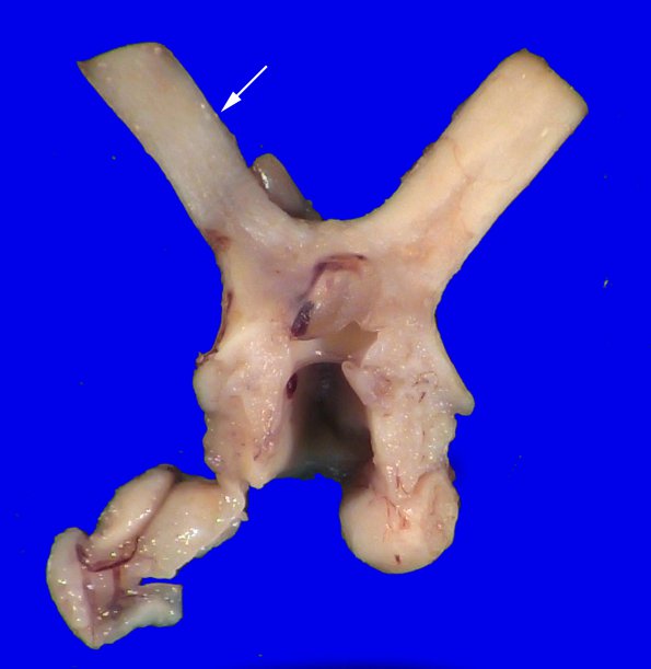 17B3 RVCL (Case 17) Gross _40