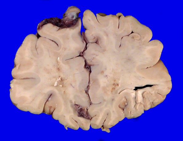17B4 RVCL (Case 17) Gross _6