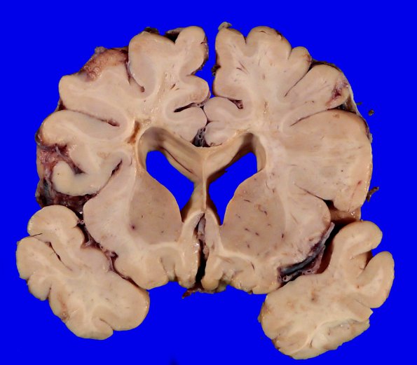 17B6 RVCL (Case 17) Gross _9