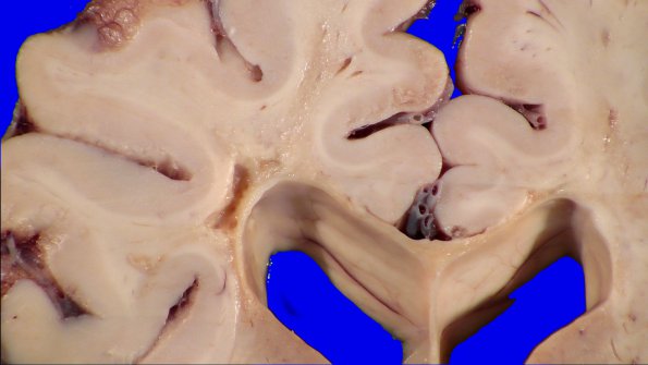 17B7 RVCL (Case 17) Gross _10