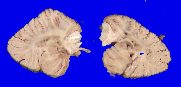 17B9 RVCL (Case 17) Gross _34 copy