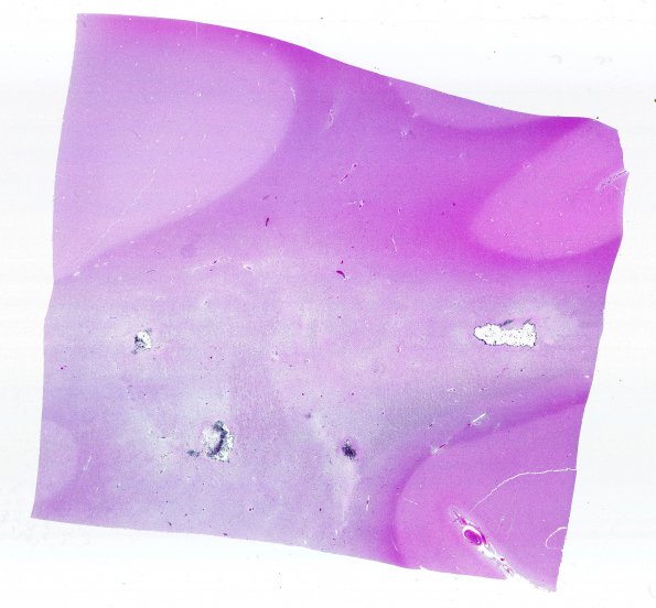 17C1 RVCL (Case 17) N12 WM