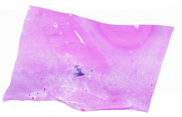 17C2 RVCL (Case 17) N13 WM 2