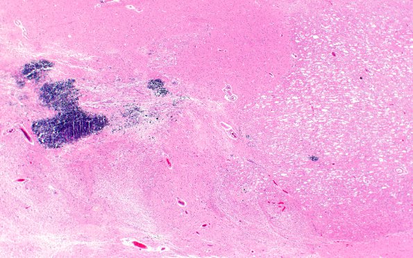 17C3 RVCL (Case 17) N13 H&E 2X