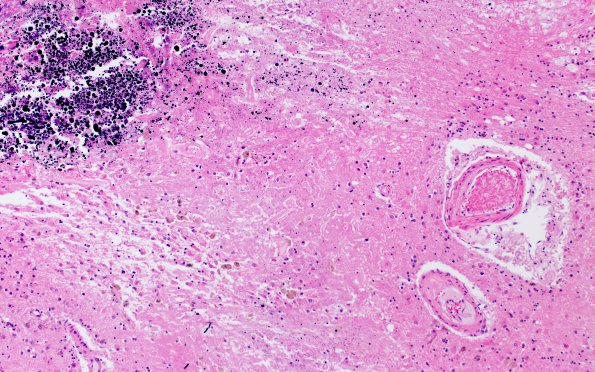 17C5 RVCL (Case 17) N13 H&E 10X