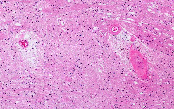 17C6 RVCL (Case 17) N13 H&E 10X 2