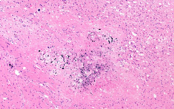 17C7 RVCL (Case 17) N13 H&E 10X 3