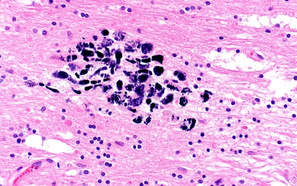 17C9 RVCL (Case 17) N13 H&E 40X 2