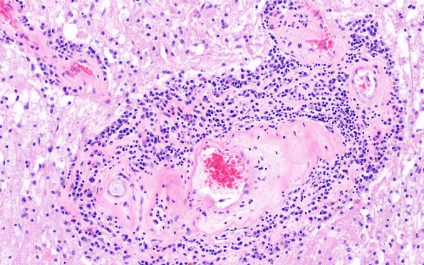 17D2 RVCL (Case 17) N4 20X