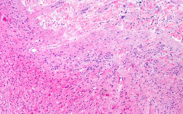 17E RVCL (Case 17) N11 Optic nerve H&E 10X