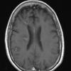 18A1 TREX1 Disease (Case 18) 2-2018 T1W 4 - Copy