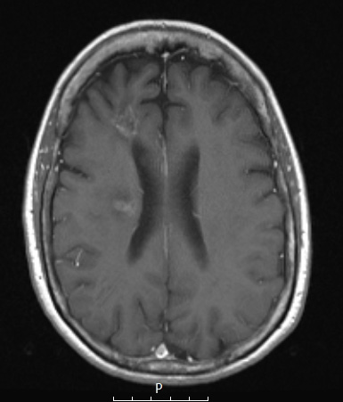 18A1 TREX1 Disease (Case 18) 2-2018 T1W 4 - Copy