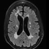 18A3 2023 TREX1 Disease (Case 18) 1-2023 FLAIR - Copy