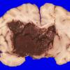 18B1 TREX1 Disease (Case 18) Gross_3