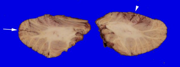 18B6 TREX1 Disease (Case 18) Gross_2 copy