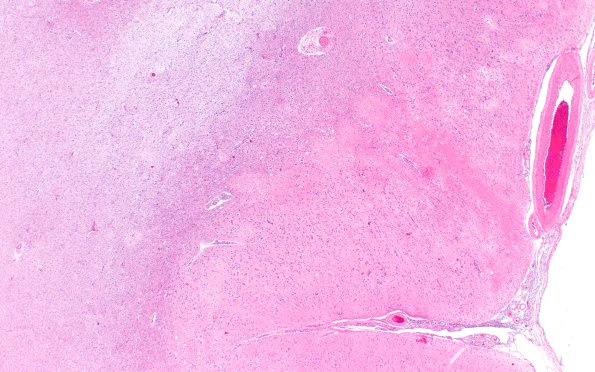 18C2 TREX1 Disease (Case 18) H&E N22 2X