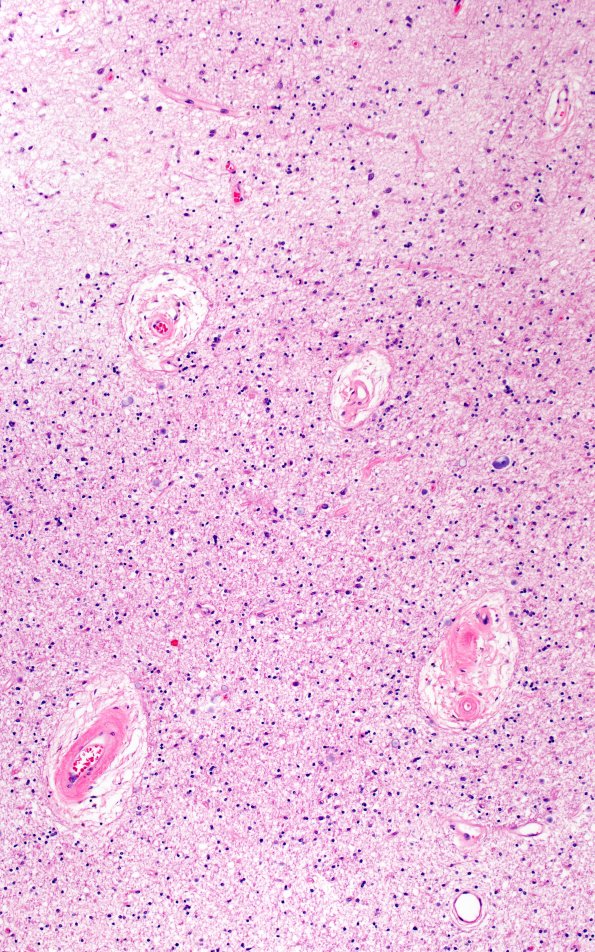 18C4 TREX1 Disease (Case 18) H&E N22 10X 5