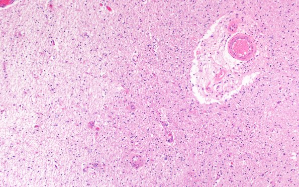 18C5 TREX1 Disease (Case 18) H&E N22 10X 2