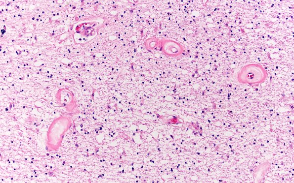 18C6 TREX1 Disease (Case 18) H&E N22 10X 4