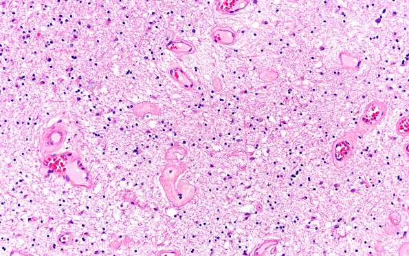 18C7 TREX1 Disease (Case 18) H&E N22 20X